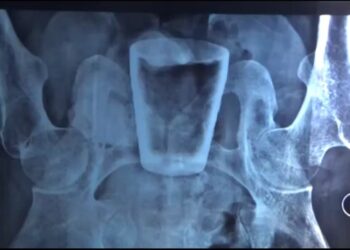 Viral Gelas Kaca Bersarang di Perut Pria asal Jember, Gimana Masuknya Ya?