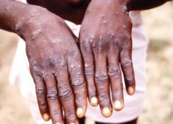 Siapa Bilang Cacar Monyet Tak Berbahaya? Di Nigeria Sudah Ada yang Mati!