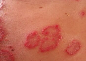 Dinkes P2kb Kabupaten Nunukan Siap Eradikasi Frambusia